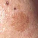 トレチノイン療法