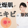 乾燥肌がニキビの原因になるって本当?予防と改善対策 | エイジングケアを本気で学ぶ